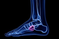 Possible Complications From Cuboid Syndrome