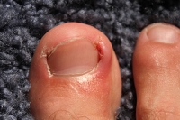 Understanding the Basics of Ingrown Toenails