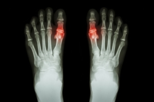 Understanding Painful Gout