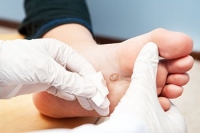 Triggers of Plantar Warts