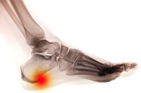 Definition and Diagnosis of Heel Spurs
