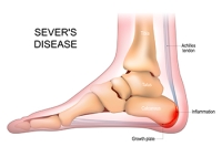 Sever's Disease and Its Rarity in Adults